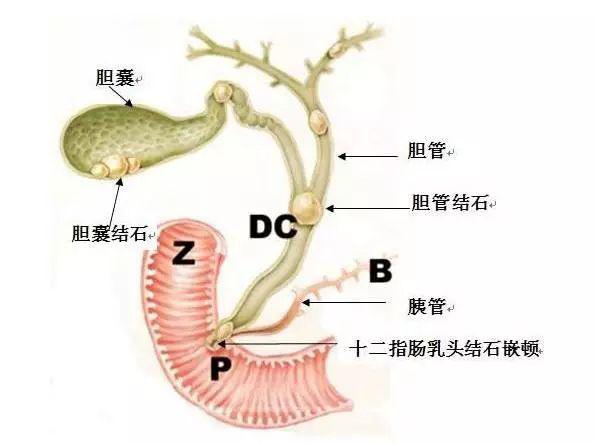 胆囊局限性腺肌症如何治疗,胆囊局限性腺肌症的治疗与状况评估解析说明,实地数据解释定义_牙版95.54.94