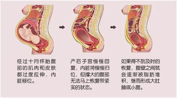 子宫下垂怎么治疗最好方法