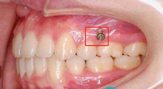 牙齿矫正牙龈被挤出一块肉