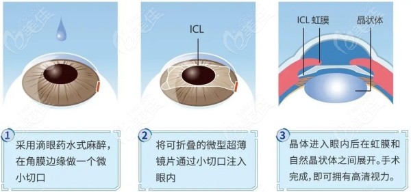 爱尔眼科医院近视手术价格表南昌