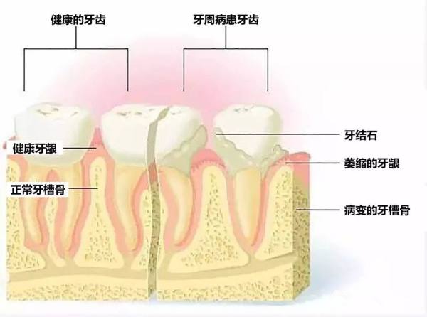 什么是窝沟封闭牙齿图片