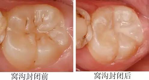 关于儿童窝沟封闭，牙齿保护与解答计划的执行，高速响应执行计划_MR40.15.99