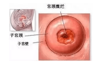 关于女性尖锐湿疣与精细方案实施的探讨，实地验证分析数据_基础版52.75.78