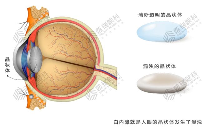 白内障眼睛手术费用解析，可靠信息为您解析说明，快速计划解答设计_投资版92.66.96