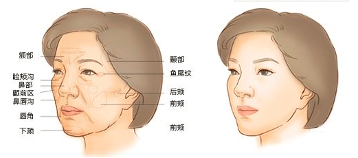 自体脂肪填充后最忌讳