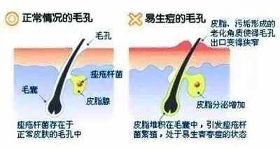 青春痘简单治疗方法